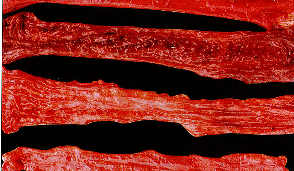 猪传染性胃肠炎病症状图片与彩色图谱-肠黏膜潮红充血及弥漫性出血症状解剖图片